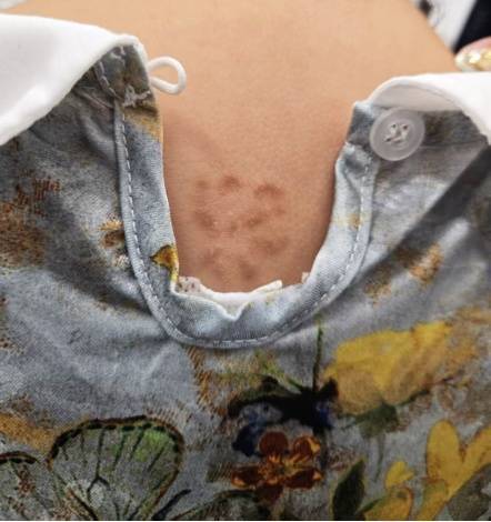 皇冠信用盘结算日是哪天_杭州5岁女孩背上惊现“梅花印”皇冠信用盘结算日是哪天，罪魁祸首竟是家里的……